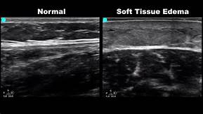 soft tissue