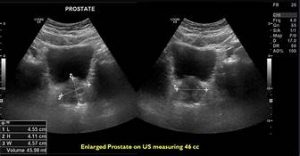 prostate