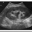 renal